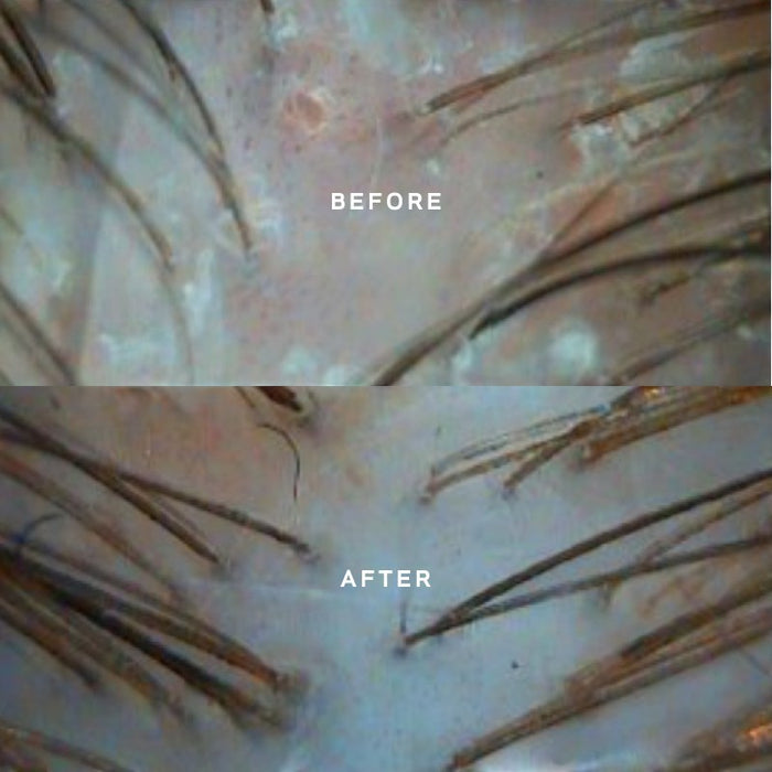 Shop Rescue Spa Black Baccara hair treatment before and after scalp analysis showing improved hair density and health